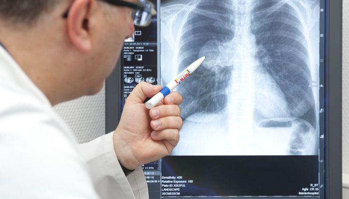 В Первоуральске показатель заболеваемости туберкулеза выше областного