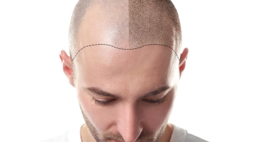 Пересадка волос на голове