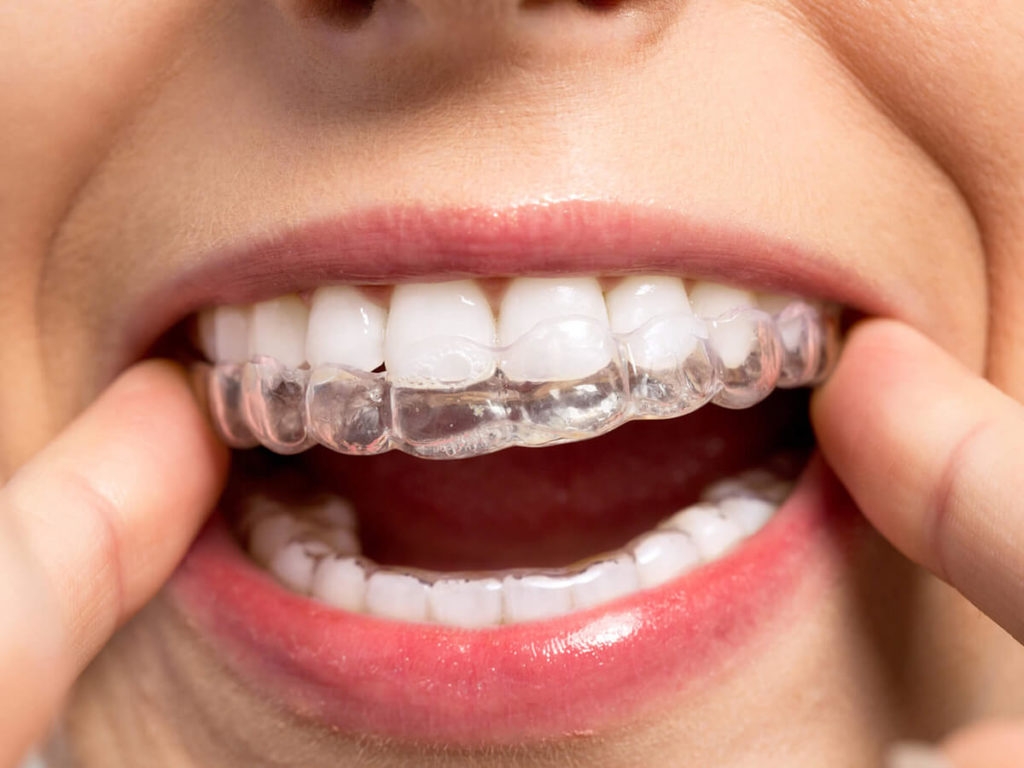 Выровняйте зубы с помощью элайнеров: быстро, эстетично, без брекетов