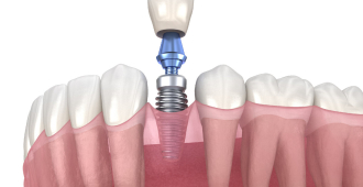 Этапы процедуры имплантации зубов