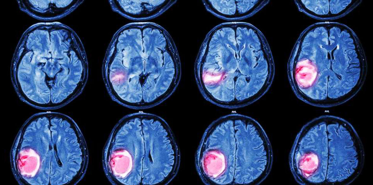На учёте у первоуральских онкологов состоят более 50 человек