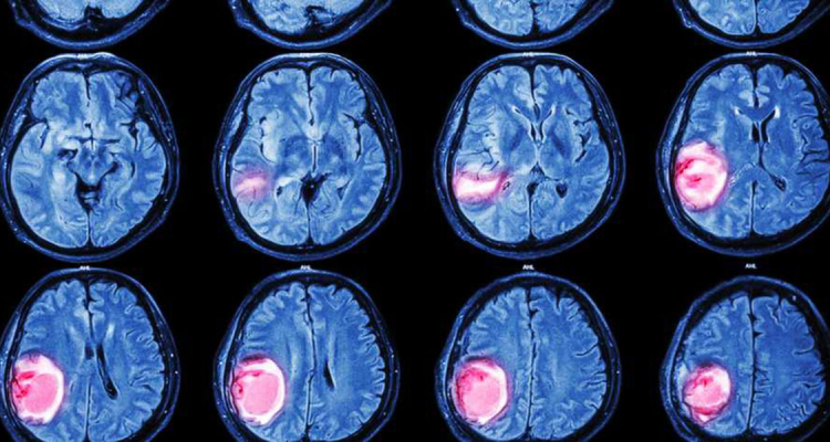 На учёте у первоуральских онкологов состоят более 50 человек